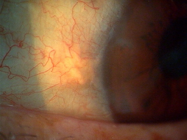 瞼 裂 斑 と は