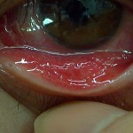 流行性角結膜炎（下眼瞼結膜）