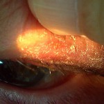図３．眼瞼炎（初診時）