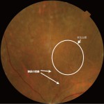 網膜静脈閉塞症による新生血管