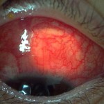 episcleritis