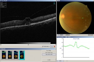 硝子体黄斑牽引症候群