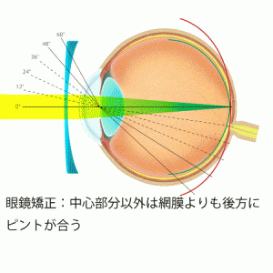 眼鏡装用による近視化