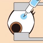 白目の部分に注射針を刺し、眼の中に抗VEGF薬を注射します。 注射針が入る感覚はありますが、痛みはほとんどありません。