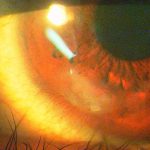 角膜フリクテン